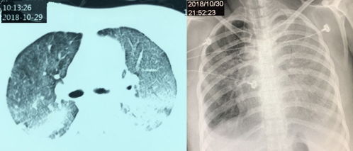 医术守护生命 中国医大一院重症医学科成功抢救重症肺炎产妇